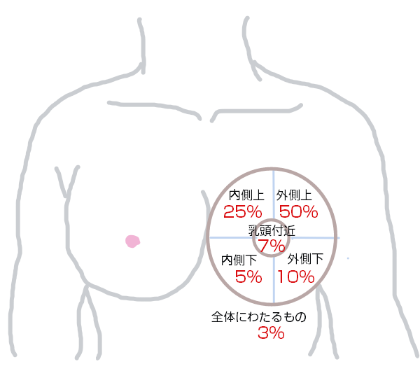 乳がん部位